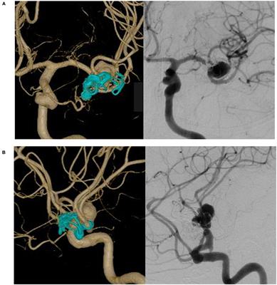 Staged Hybrid Techniques With Straightforward Bypass Surgery Followed by Flow Diverter Deployment for Complex Recurrent Middle Cerebral Artery Aneurysms